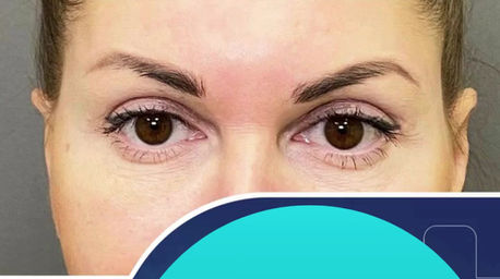 Blepharoplasty Upper/Lower